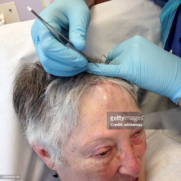 remover pontos de uma senhora idosa's cabeça - head wound - fotografias e filmes do acervo