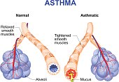 inflamation of the bronchus causing asthma