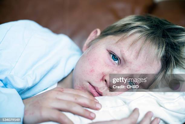 measles - measles stockfoto's en -beelden