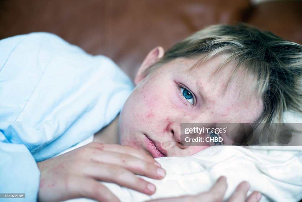 Measles