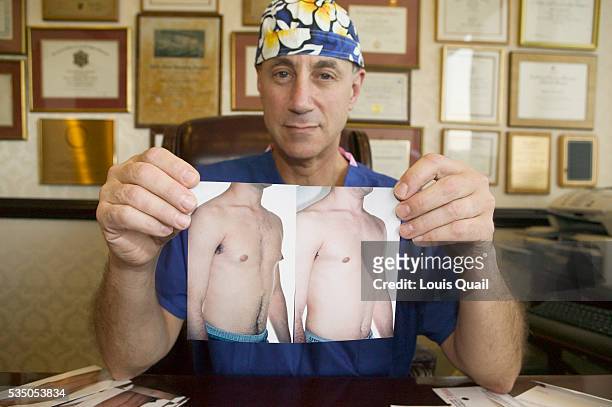 Daniel Johnson had gynecomastia surgery in 2004, aged 17 in Long Island. Here his surgeon Dr Gold shows before and after photographs of Daniel. His...