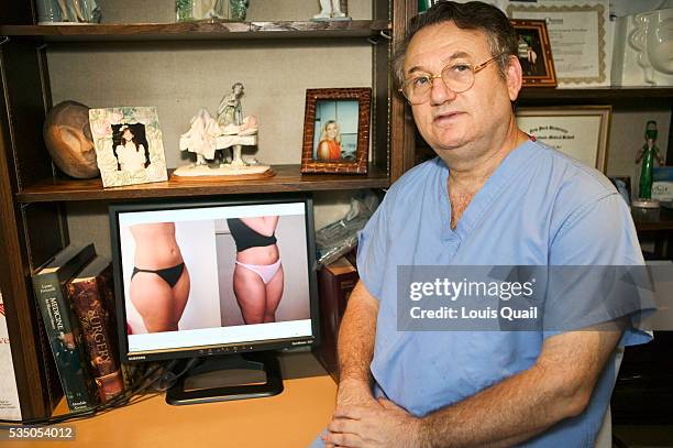 Dr Blau, surgeon, showing the before and after pictures of Melanie Gompers' liposuction operation. Melanie Gompers lives in New York and works as a...