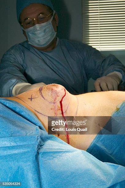 Matt Anderson is a student in New York. He underwent gynecomastia surgery in 2005 at a cost of $6,000. Here during his operation with Dr Blau after...