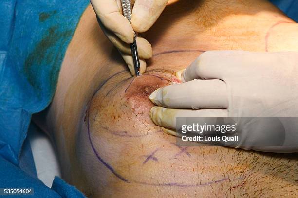 Matt Anderson is a student in New York. He underwent gynecomastia surgery in 2005 at a cost of $6,000. Here during his operation with Dr Blau the...