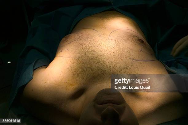 Matt Anderson is a student in New York. He underwent gynecomastia surgery in 2005 at a cost of $6,000. Here Matt shortly before his operation with Dr...