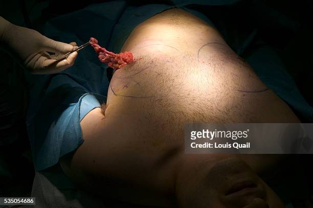 Matt Anderson is a student in New York. He underwent gynecomastia surgery in 2005 at a cost of $6,000. Here Matt has tissue removed from his breast...