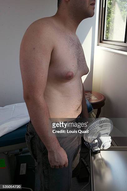 Matt Anderson is a student in New York. He underwent gynecomastia surgery in 2005 at a cost of $6,000. Here immediately before his operation with Dr...