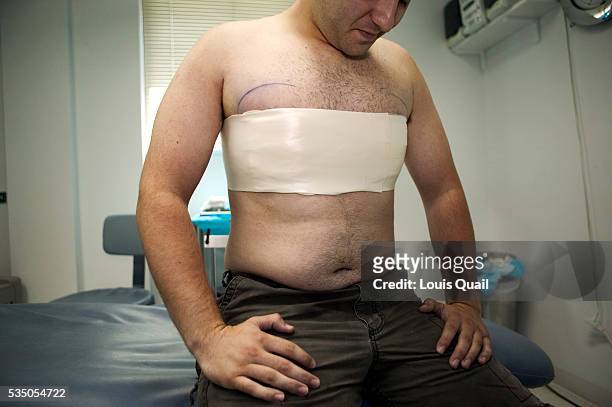 Matt Anderson is a student in New York. He underwent gynecomastia surgery in 2005 at a cost of $6,000. Here immediately after his operation with Dr...