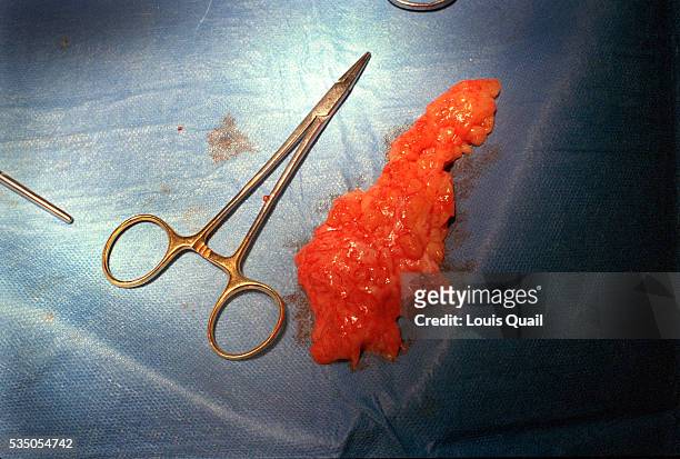 Matt Anderson is a student in New York. He underwent gynecomastia surgery in 2005 at a cost of $6,000. Here tissue removed from Matt's breast during...