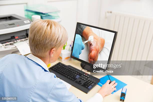 nurse at work,watching picture of halux valgus operation - nurse wound stock pictures, royalty-free photos & images
