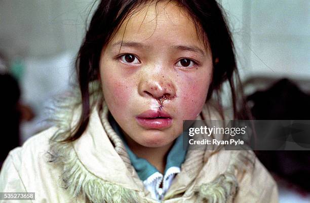 Dandan Men, 11 years old, after surgery. She has travelled over 100 km to receive a free Cleft Lip and Cleft Palate surgery today at Suqian People's...