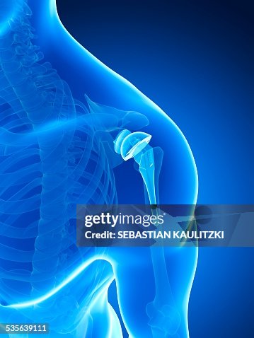Human shoulder replacement, artwork Human shoulder replacement, artwork