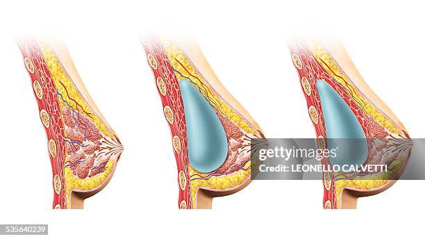 female breast implant, cut away , artwork - plastic surgery stock illustrations