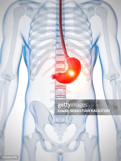 human stomach ulcer, illustration - gastric ulcer stock illustrations