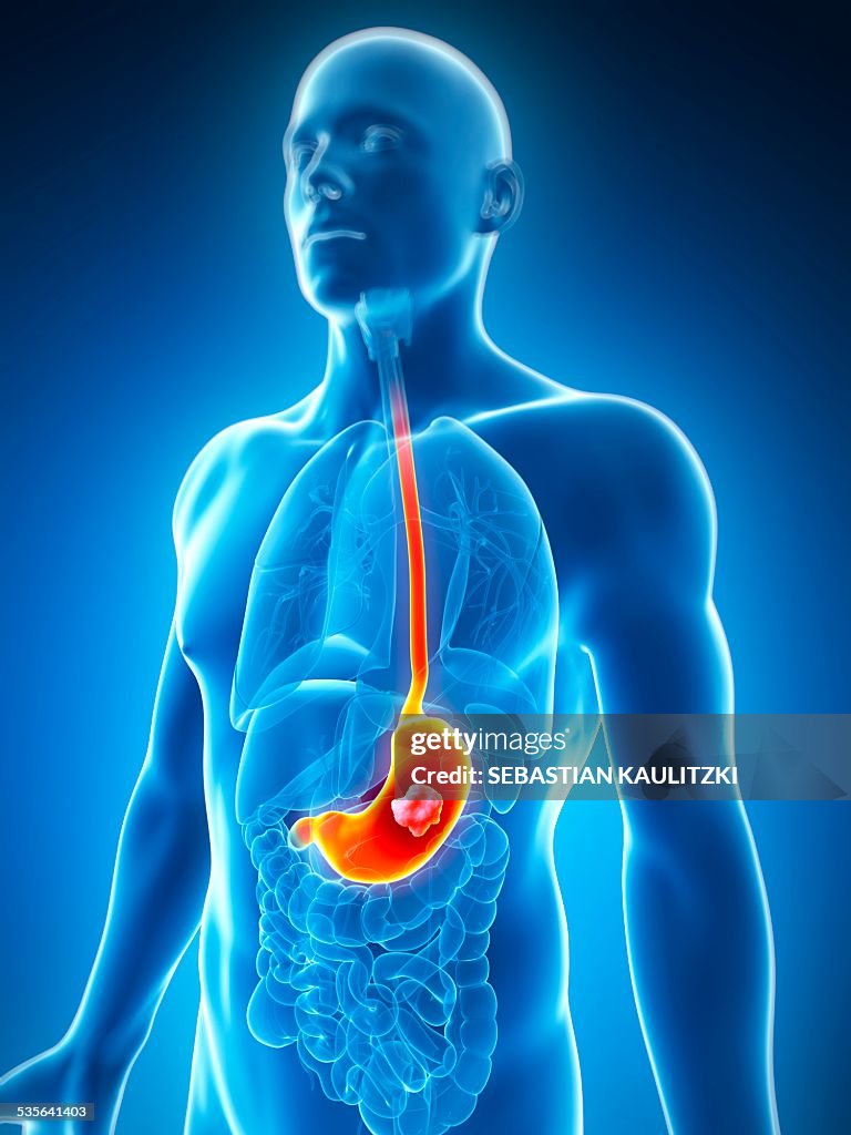 Human stomach ulcer, illustration