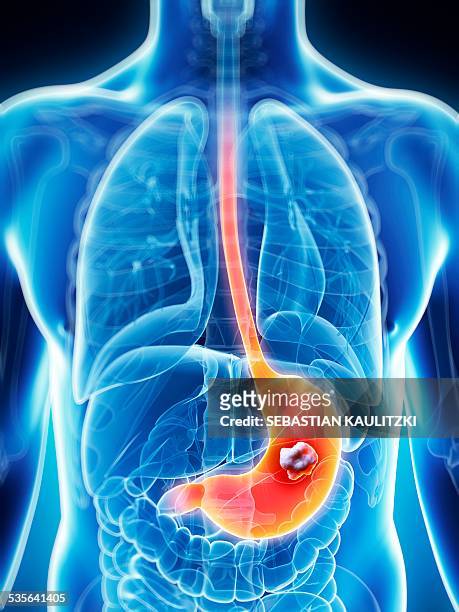 human stomach cancer, illustration - belly stock illustrations