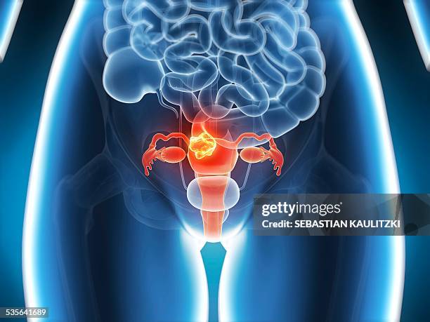 cancer of the uterus, illustration - cancer stock-grafiken, -clipart, -cartoons und -symbole