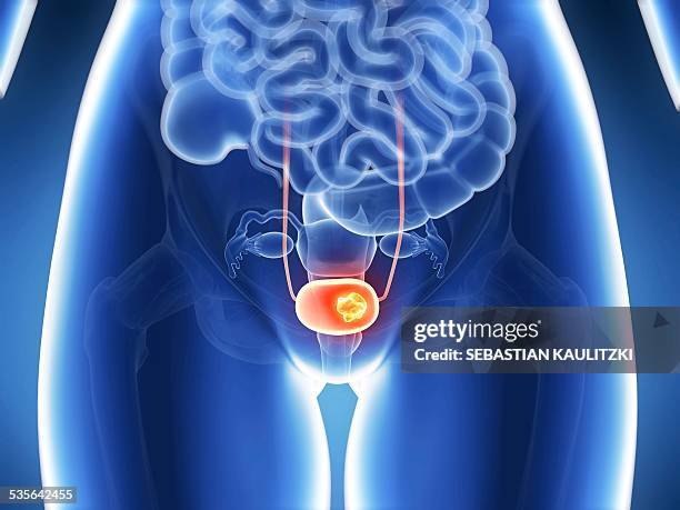 human bladder cancer, illustration - bladder stock illustrations