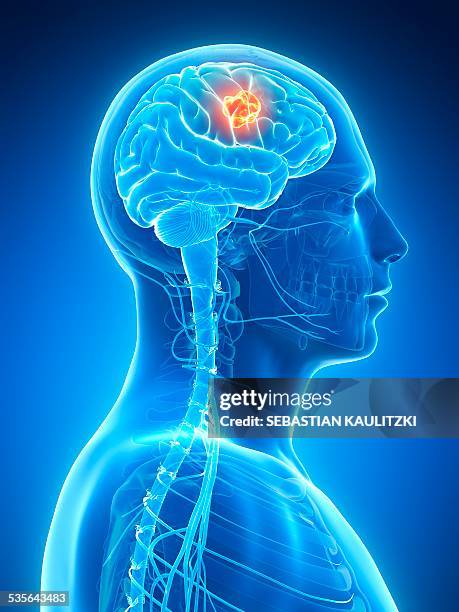 human brain tumor, illustration - brain tumour stock illustrations