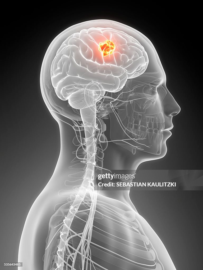 Human brain tumor, illustration