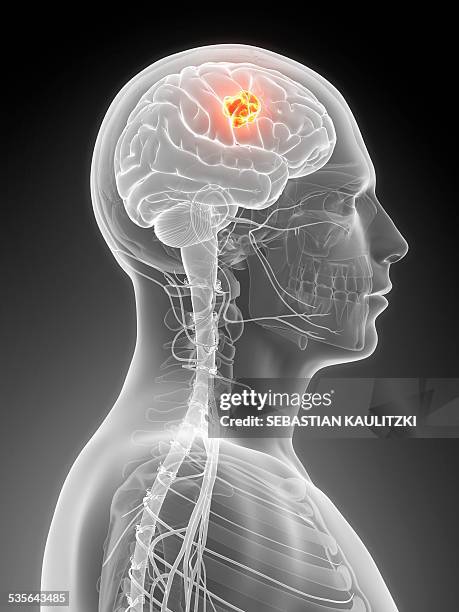 human brain tumor, illustration - brain tumour stock illustrations