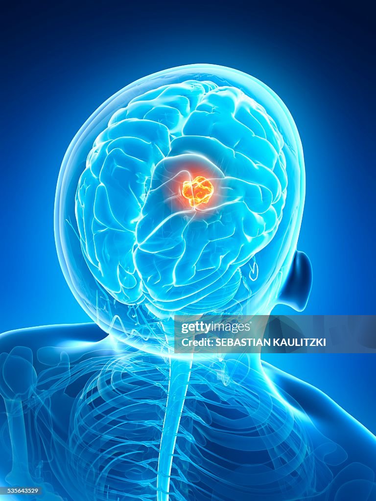 Tumor Examples Human Human Brain Tumor Illustration High-Res Vector Graphic - Getty Images