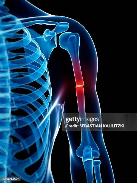 broken arm bone, illustration - knochenbruch stock-grafiken, -clipart, -cartoons und -symbole
