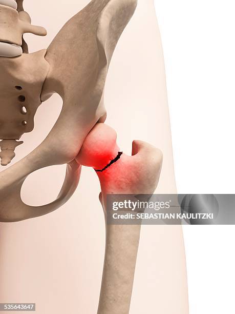 broken hip bone, illustration - knochenbruch stock-grafiken, -clipart, -cartoons und -symbole