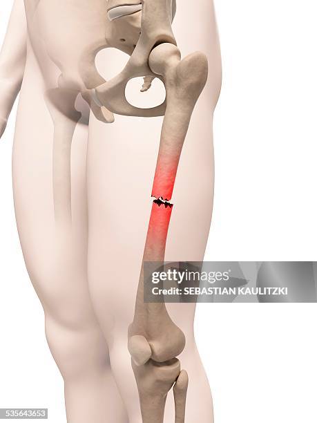 broken thigh bone, illustration - knochenbruch stock-grafiken, -clipart, -cartoons und -symbole