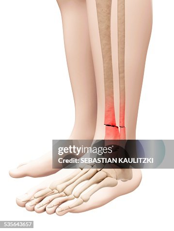 Broken leg bone, illustration Broken leg bone, illustration