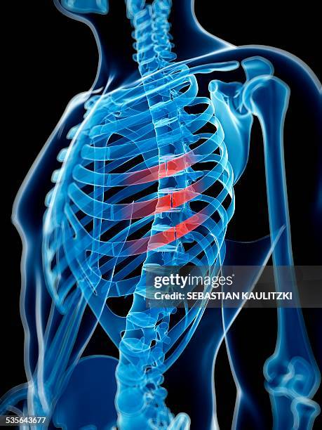 bildbanksillustrationer, clip art samt tecknat material och ikoner med broken ribs, illustration - rib cage