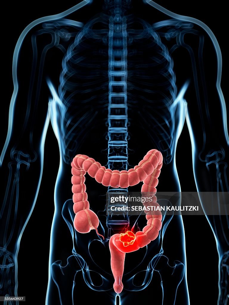 Human colon cancer, illustration