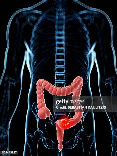 human colon cancer, illustration - colon stock illustrations