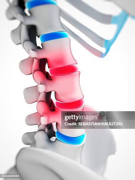 Disc In Human Body 360 Spine Discs Stock Photos, High-Res Pictures, and Images - Getty Images