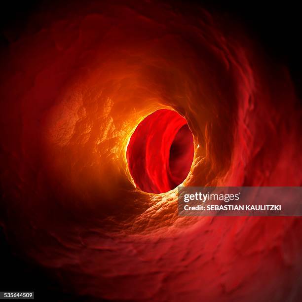 arteriosclerosis, illustration - arteriosklerose stock-grafiken, -clipart, -cartoons und -symbole