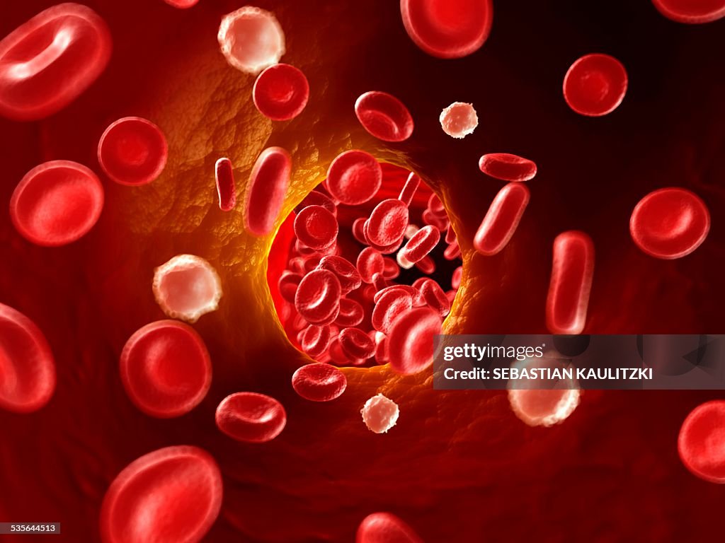 Arteriosclerosis, illustration