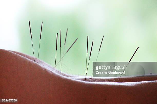 woman with acupuncture needles in her back - acupuncture stockfoto's en -beelden