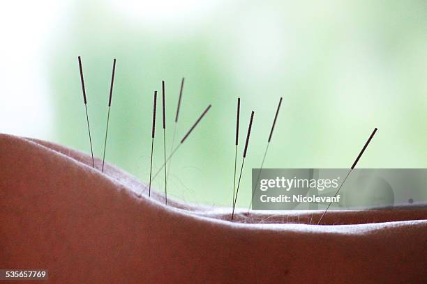 woman with acupuncture needles in her back - acupuncture stock pictures, royalty-free photos & images