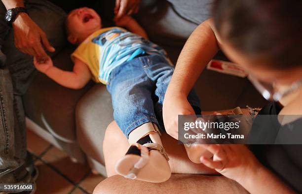 David Henrique Ferreira, 9-months-old, who was born with microcephaly, has orthopedic boots placed on his feet by his mother Mylene to help correct...