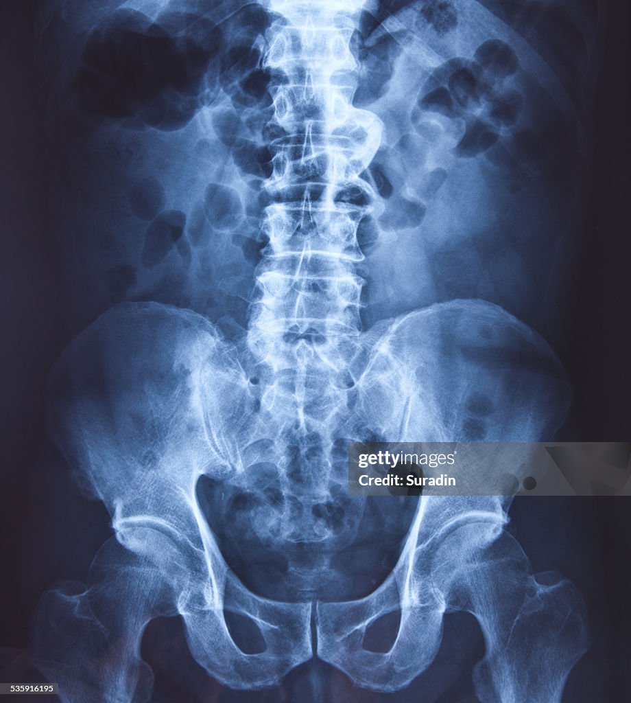 X-ray of the pelvis and spinal column