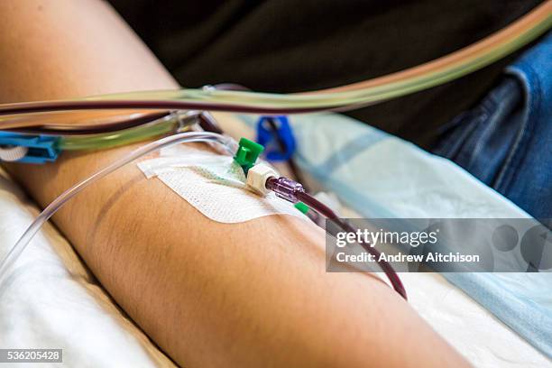 Cannula placed into a patient's arm to collect blood for a stem cell donation transfusion in the London clinic, London, United Kingdom. Once the stem...