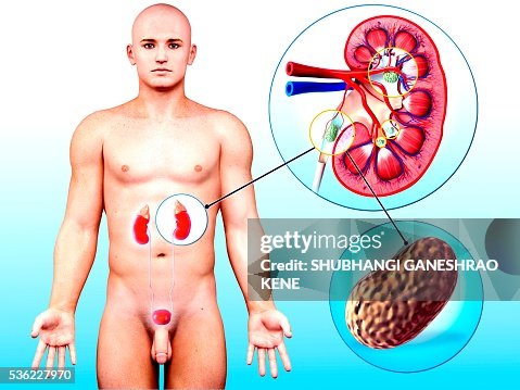 Human kidney stones, computer artwork. Human kidney stones, computer artwork.