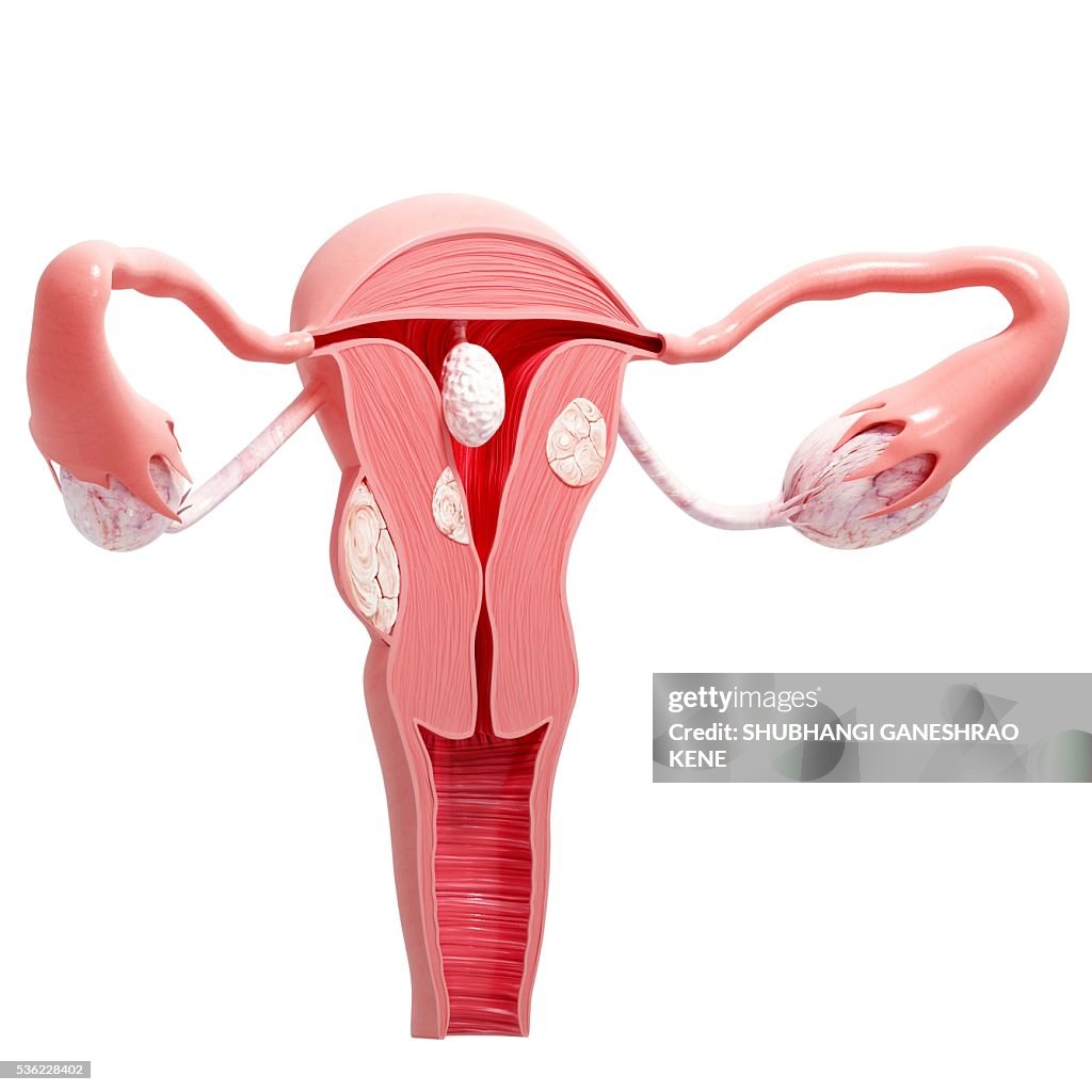 Uterine cancer, computer artwork.