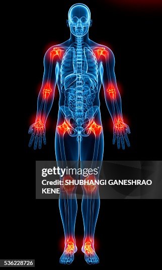 Joint pain, computer artwork. Joint pain, computer artwork.