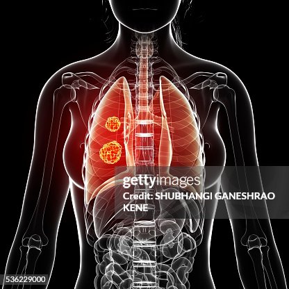 Lung cancer, computer artwork. Lung cancer, computer artwork.