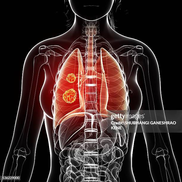 lung cancer, computer artwork. - respiratory system 幅插畫檔、美工圖案、卡通及圖標