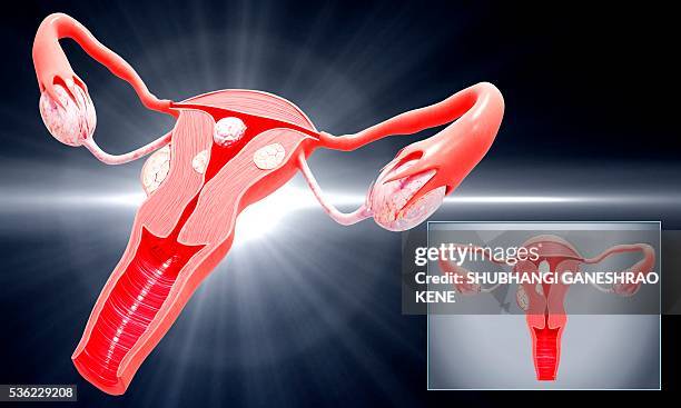 bildbanksillustrationer, clip art samt tecknat material och ikoner med uterine cancer, computer artwork. - äggledare