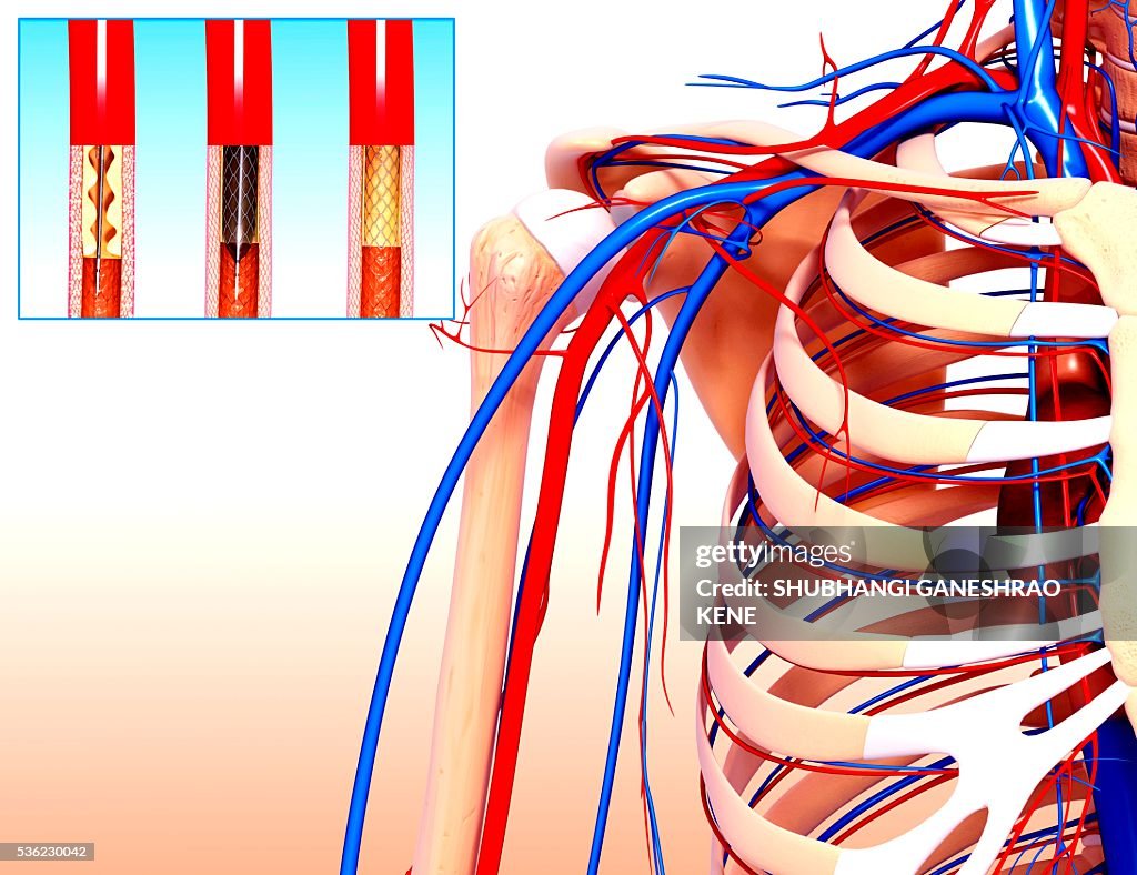 Angioplasty, computer artwork.