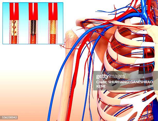 angioplasty, computer artwork. - aorta imagens e fotografias de stock