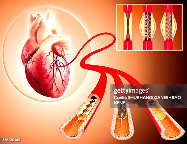 angioplasty, computer artwork. - coronary artery stock pictures, royalty-free photos & images
